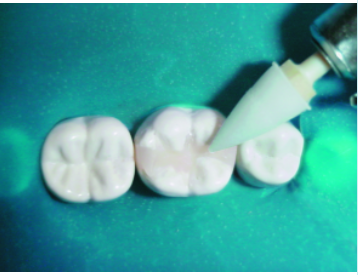 Ponta de Polimento Abrasiva de Silicone Optimize Refil - Sortido 3